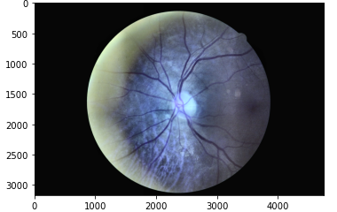 Fundus Image After CLAHE